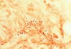 Pneumovax may not be effective Pneumovax may not be effective