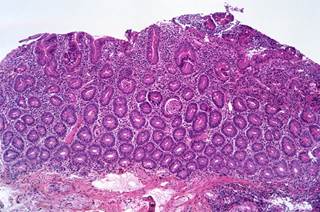 Photomicrograph of celiac disease showing complete atrophy of the duodenal villi. Photomicrograph of celiac disease showing complete atrophy of the duodenal villi.