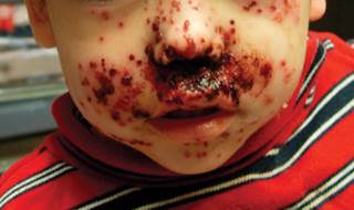 Crusted erosions on a toddler's face and extremities Crusted erosions on a toddler's face and extremities