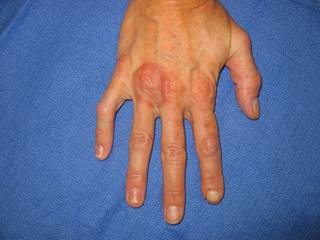 Asymptomatic red plaque on the hand of a diabetic patient Asymptomatic red plaque on the hand of a diabetic patient