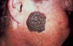 Elderly woman's thick warty lesion Elderly woman's thick warty lesion