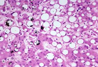 Photomicrograph shows fatty metamorphosis of a human liver. The clear vacuoles indicate fat droplets Photomicrograph shows fatty metamorphosis of a human liver. The clear vacuoles indicate fat droplets