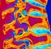 Osteoporosis: No gender gap for therapy Osteoporosis: No gender gap for therapy