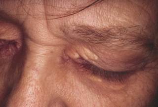 Discrete yellow lesions on the eyelid Discrete yellow lesions on the eyelid