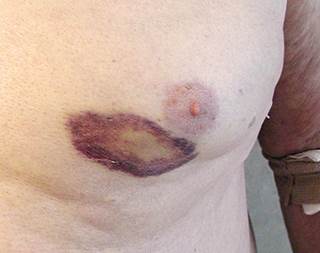 Peculiar violaceous, atraumatic rash Peculiar violaceous, atraumatic rash