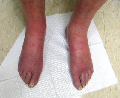 Painful pedal erythema - The Clinical Advisor