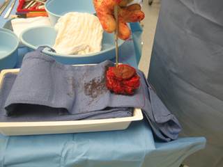 The growth removed from Gina's forearm measured 2.7 cm x 2 cm The growth removed from Gina's forearm measured 2.7 cm x 2 cm