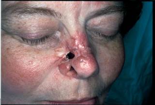 Recurrent deep ulceration exposes the nasal septum Recurrent deep ulceration exposes the nasal septum