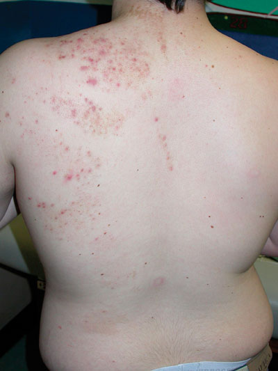 Managing acne vulgaris: Two important issues - The 