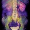 A comprehensive look at kidney stones A comprehensive look at kidney stones
