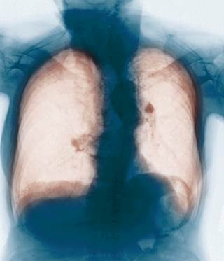 A novel technique involving NPPV reduced the risks of nosocomial infection, requirement for intubation, and hospital mortality in patients with COPD. A novel technique involving NPPV reduced the risks of nosocomial infection, requirement for intubation, and hospital mortality in patients with COPD.