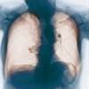 NPPV Technique More Effective in COPD Treatment NPPV Technique More Effective in COPD Treatment