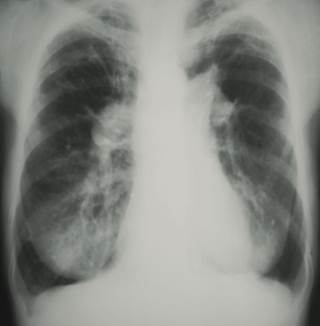 Pulmonary hypertension is characterized by increased BP in the pulmonary vasculature Pulmonary hypertension is characterized by increased BP in the pulmonary vasculature