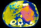 Is it time to stop indomethacin for gout? Is it time to stop indomethacin for gout?
