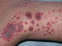The characteristic lesions of Henoch-Schonlein purpura (purple) The characteristic lesions of Henoch-Schonlein purpura (purple)