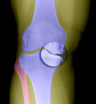 X-ray shows joint-space narrowing in a knee with osteoarthritis X-ray shows joint-space narrowing in a knee with osteoarthritis