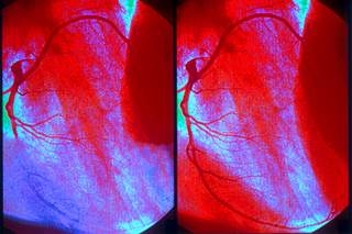 Angiogram of an MI (left) and a normal coronary artery (right) Angiogram of an MI (left) and a normal coronary artery (right)