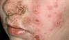 Impetigo: Taking on a common skin infection Impetigo: Taking on a common skin infection