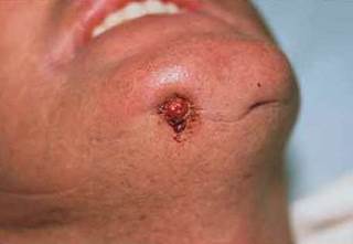 Tender, rupturing pustule on the chin Tender, rupturing pustule on the chin