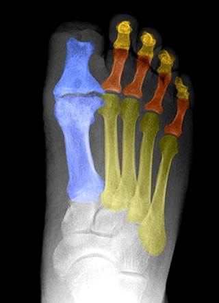 Foot x-ray of a diabetic shows evidence of amputation of the distal portion of the first toe Foot x-ray of a diabetic shows evidence of amputation of the distal portion of the first toe