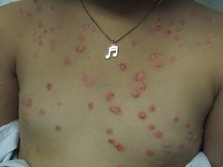 Scaly erythematous patches following a throat infection Scaly erythematous patches following a throat infection