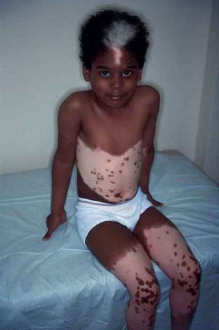Areas of varying pigmentation in a young boy Areas of varying pigmentation in a young boy