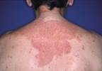 Contact dermatitis in an HIV-positive patient Contact dermatitis in an HIV-positive patient