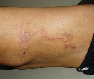 Linear serpiginous eruptions on the extremities Linear serpiginous eruptions on the extremities