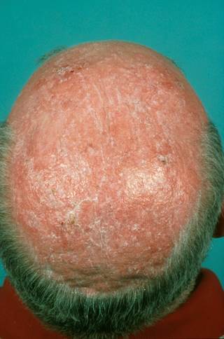 Actinic keratoses are typical in fair-skinned and elderly people Actinic keratoses are typical in fair-skinned and elderly people