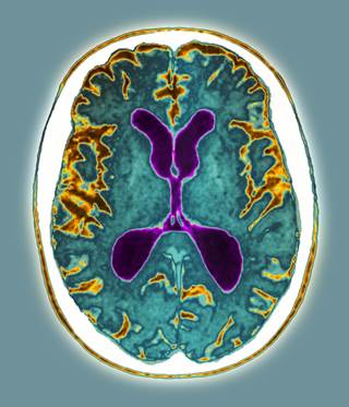 Alzheimer's disease has caused atrophy (brown areas) in both halves of this patient's brain Alzheimer's disease has caused atrophy (brown areas) in both halves of this patient's brain