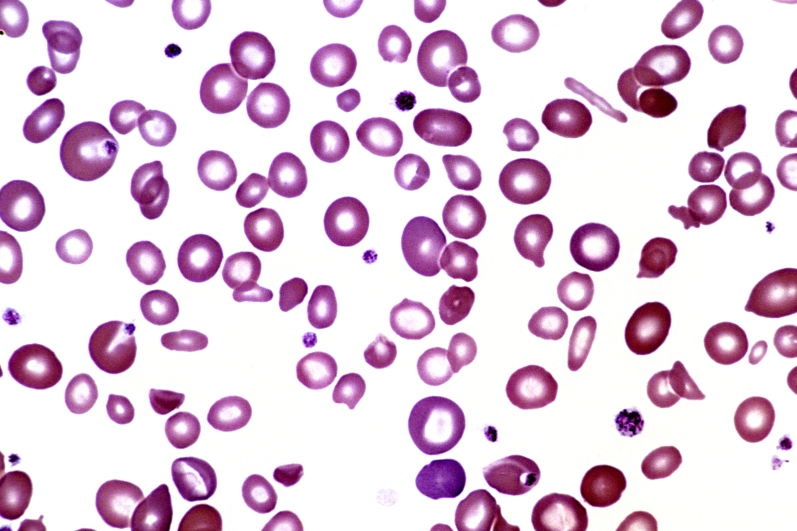 Anemia complicates CHF - The Clinical Advisor