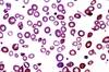 Tocilizumab Linked to Anemia Marker Improvement in Rheumatoid Arthritis Tocilizumab Linked to Anemia Marker Improvement in Rheumatoid Arthritis