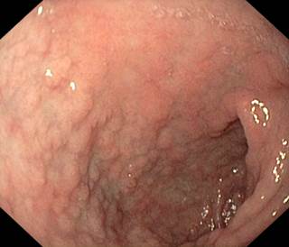 In celiac disease, the lining of the intestine reacts to gluten In celiac disease, the lining of the intestine reacts to gluten