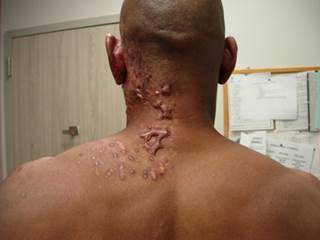 Enlarging purple pruritic nodules on the dorsal neck Enlarging purple pruritic nodules on the dorsal neck