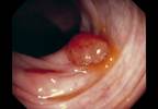 Morning colonoscopy may detect more Morning colonoscopy may detect more