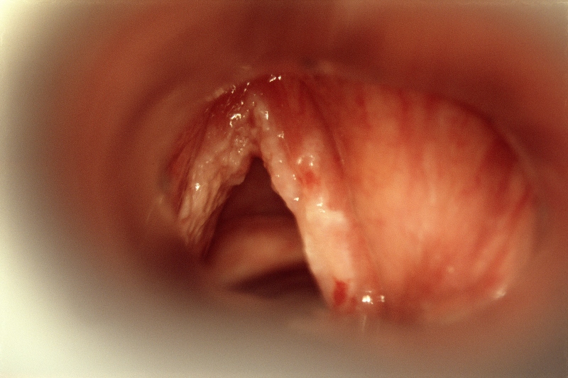 Guideline finally gives voice to hoarseness - The Clinical 