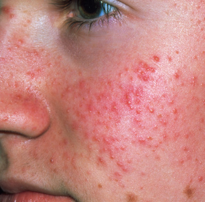 Choosing the best treatments for acne - The Clinical Advisor