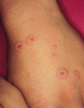 Target lesions in a patient with acne Target lesions in a patient with acne