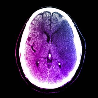 Large infarction in the middle cerebral artery (dark blue) Large infarction in the middle cerebral artery (dark blue)