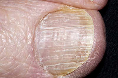 Four nail disorders every clinician should know - The Clinical Advisor