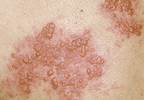 Shingles can be treated—and now prevented Shingles can be treated—and now prevented
