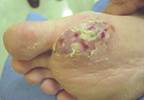 Nonhealing painless ulcer on the sole Nonhealing painless ulcer on the sole