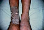 Persistent plaque with severe intermittent pruritus Persistent plaque with severe intermittent pruritus