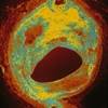 Lowering CVD risk among pediatric patients Lowering CVD risk among pediatric patients