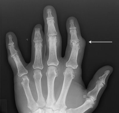 Hyperuricemia and gout are on the rise - The Clinical Advisor