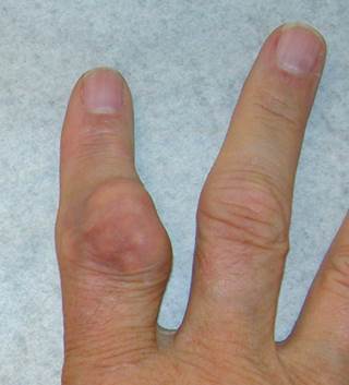 Accumulation of uric acid crystals in the joints causes inflammation. Accumulation of uric acid crystals in the joints causes inflammation.