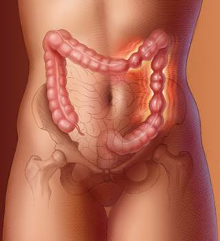 In most cases, colonic imaging is not necessary to diagnose IBS. In most cases, colonic imaging is not necessary to diagnose IBS.