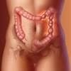 Irritable bowel syndrome made simple Irritable bowel syndrome made simple