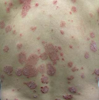 Erythematous truncal plaques Erythematous truncal plaques