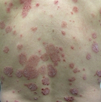 Erythematous truncal plaques - The Clinical Advisor